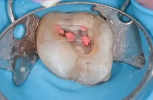 Root canal retreatment in Bangalore